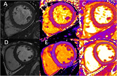 Cardiac magnetic resonance imaging parameters show association between myocardial abnormalities and severity of chronic kidney disease
